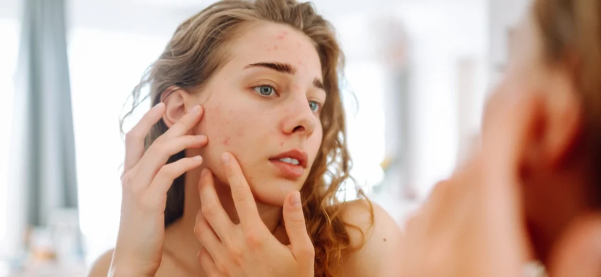 Acné hormonal en diferentes etapas de la mujer